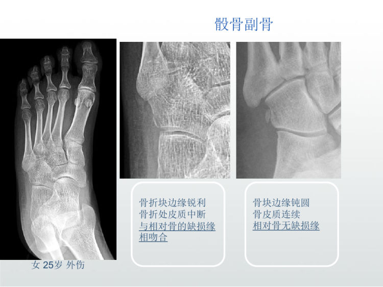 骨变异与撕脱骨折影像鉴别诊断PPT