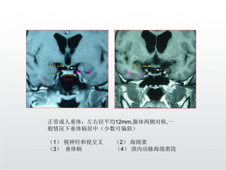 垂体微腺瘤影像诊治PPT