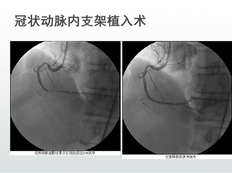 经皮冠状动脉介入诊断治疗护理PPT