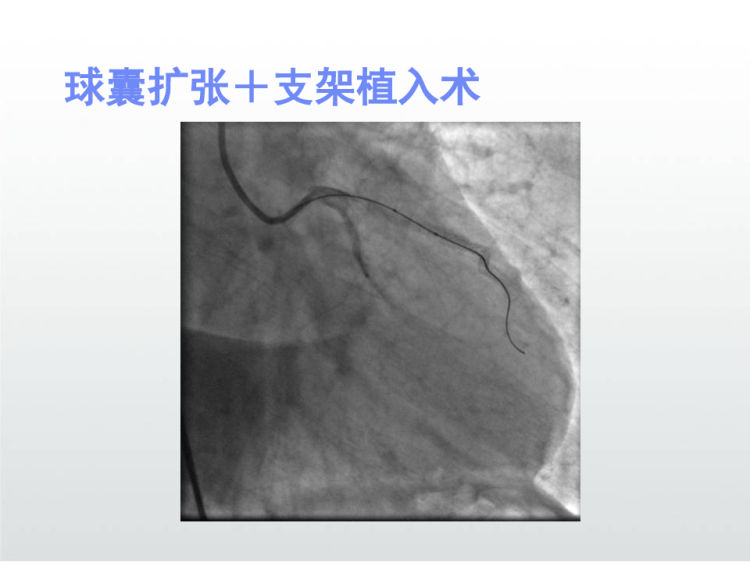 心绞痛及心肌梗死PPT