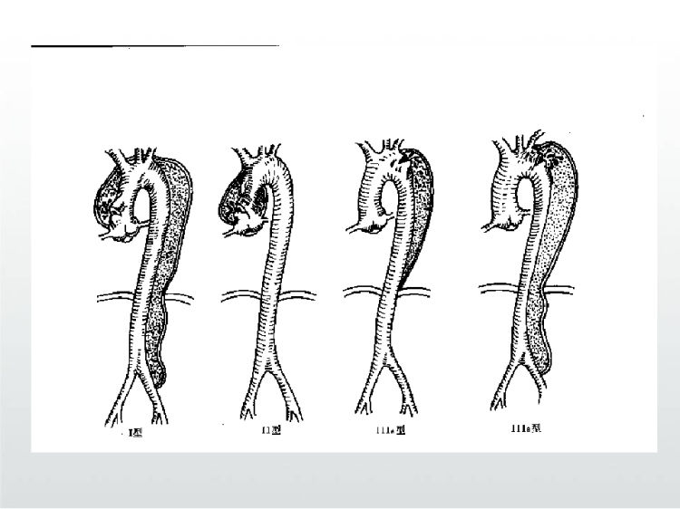 急性主动脉夹层PPT