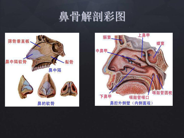 鼻骨骨折影像诊断PPT