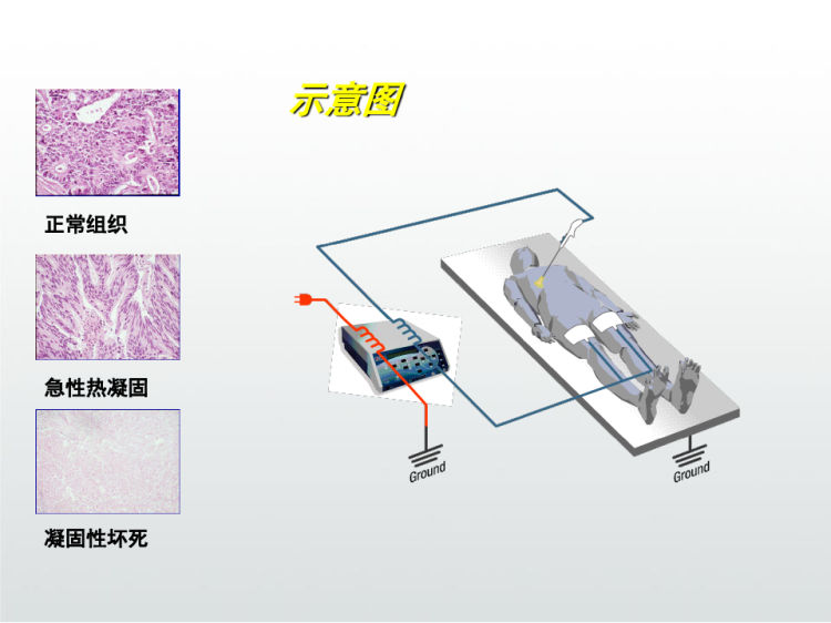 肺癌射频消融术PPT