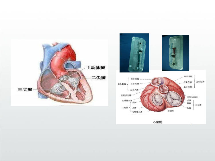 主动脉置换术疑难病例讨论PPT