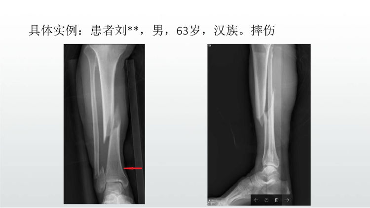 胫骨干合并后踝骨折PPT