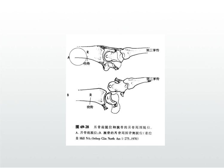 月骨脱位和周围脱位诊断治疗PPT