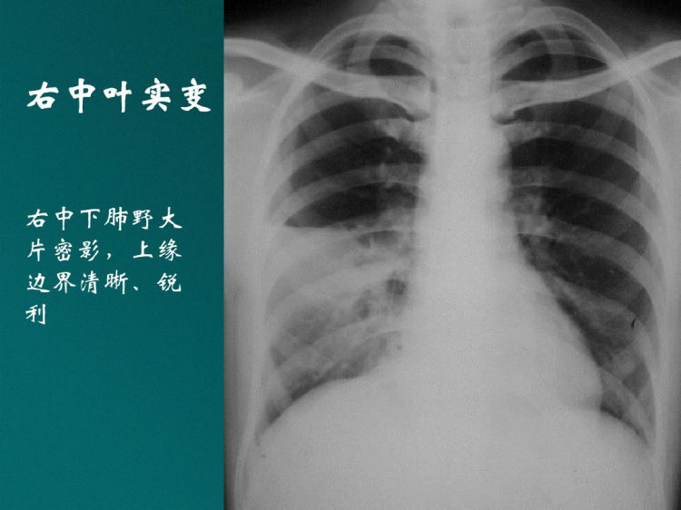 肺与纵隔基本病变影像学诊断PPT