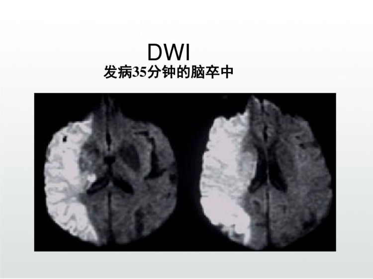 脑血管疾病CT磁共振影像诊断PPT