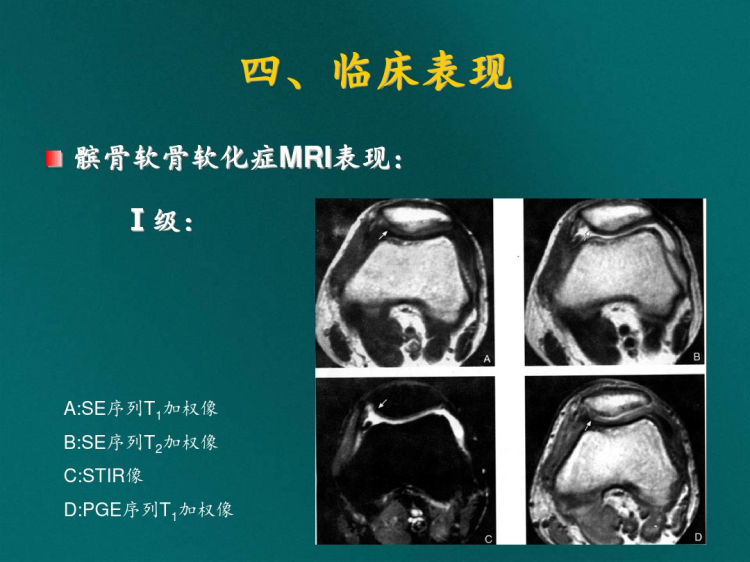 髌骨软骨软化症PPT