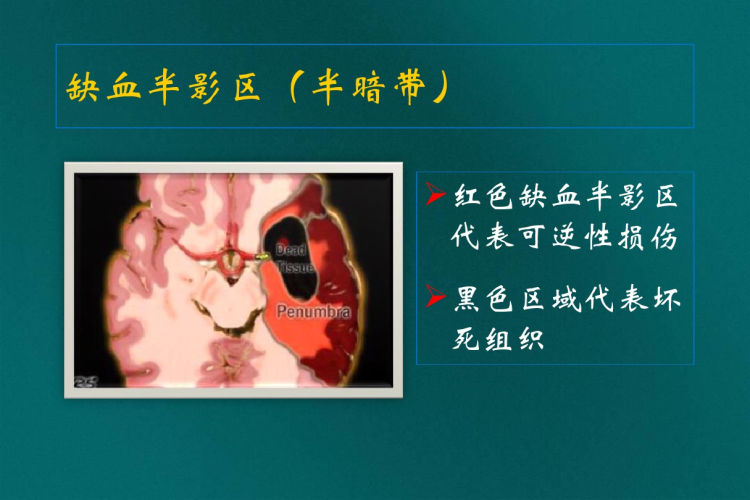 急性脑梗死缺血影像诊断PPT