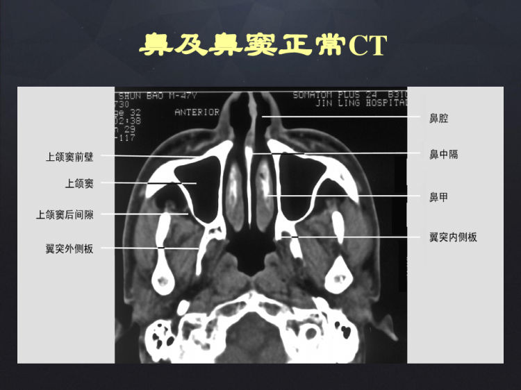 鼻与鼻窦影像表现诊断PPT