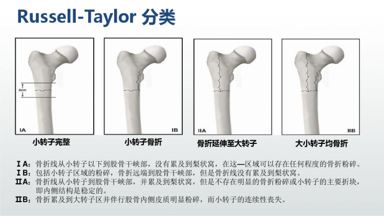 股骨近端骨折转子间转子下骨折PPT