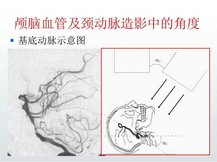 脑血管介入操作中角度选择PPT