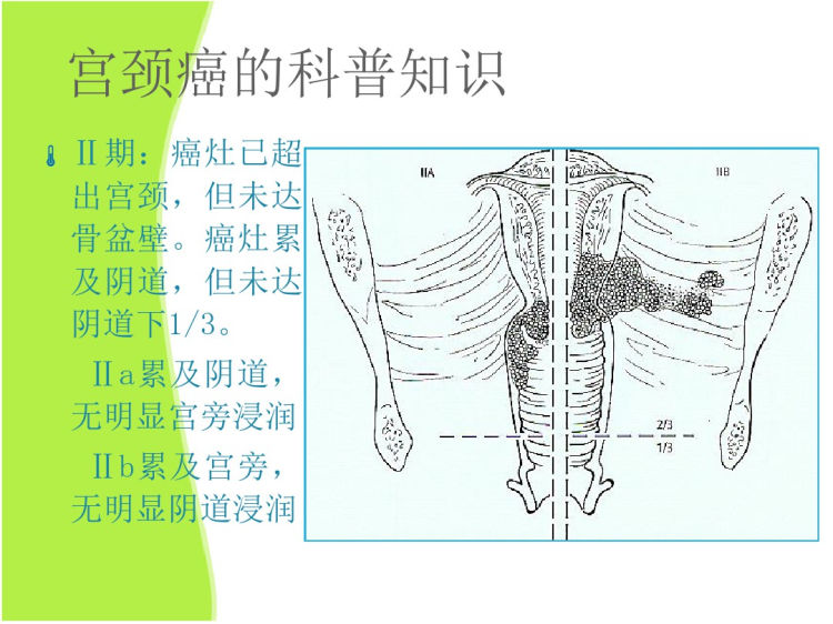 宫颈癌广泛性子宫切除与盆腔淋巴结清扫手术配合PPT