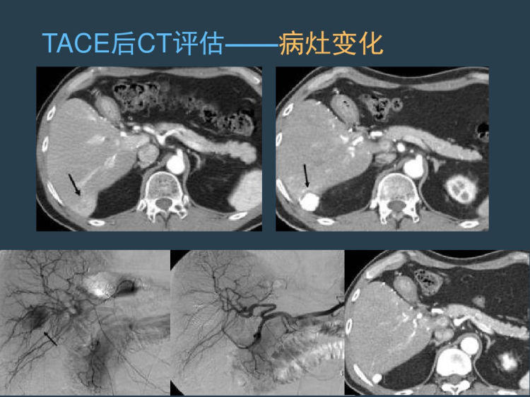 肝癌介入治疗影像诊断PPT