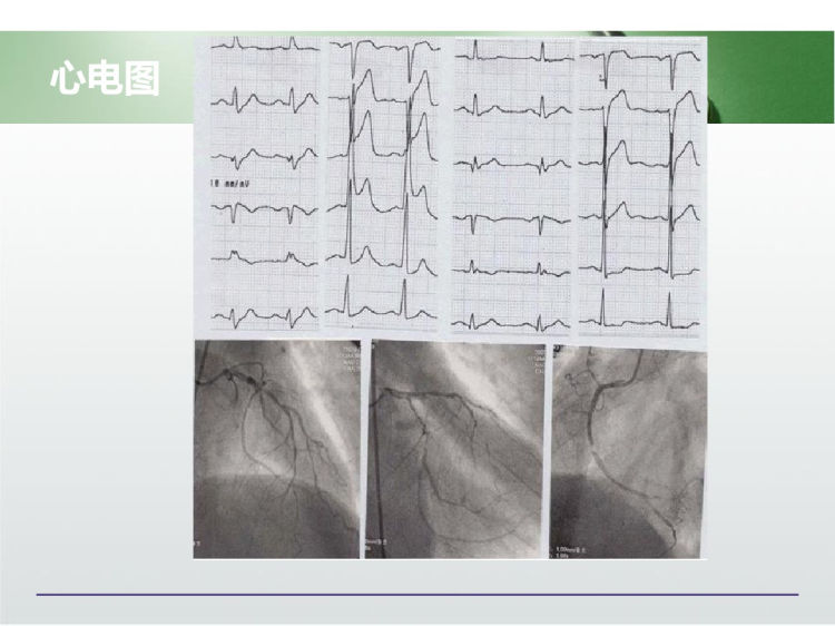 心绞痛护理PPT