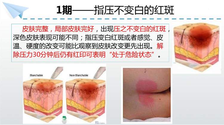 压力性损伤分期处理PPT