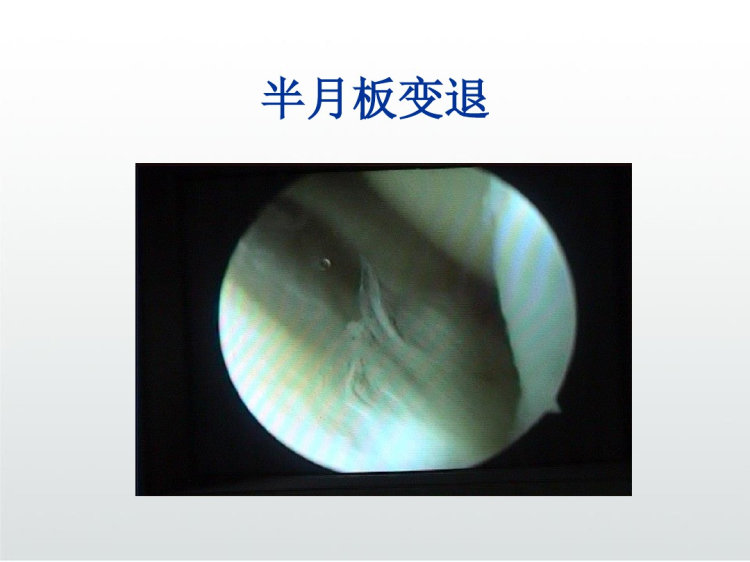 膝关节镜护理业务查房PPT