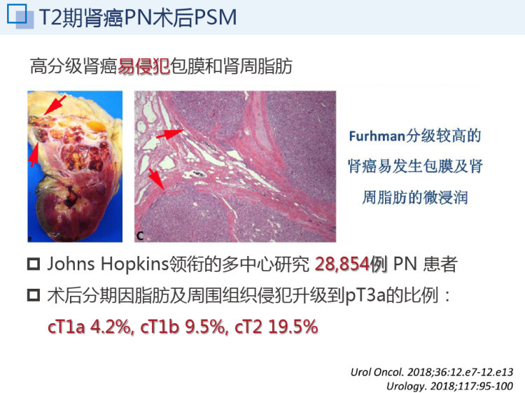 把握原则做PN保肾又保功PPT