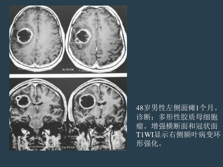 颅内肿瘤CT磁共振影像鉴别诊断PPT