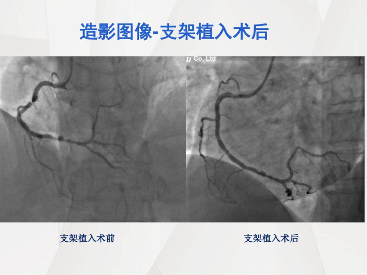 急性ST段抬高型心肌梗死教学查房PPT