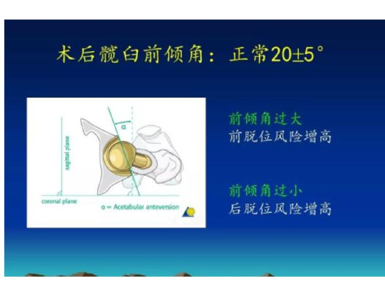 人工髋关节置换术后影像评估PPT