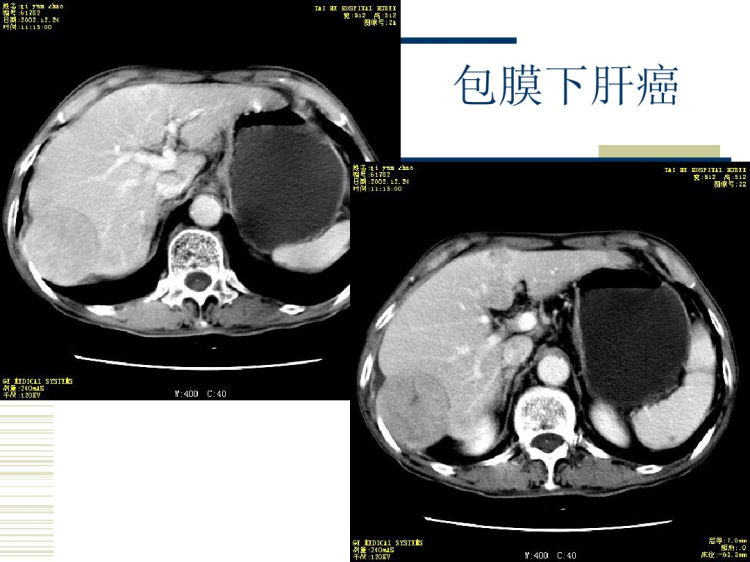 肝脏恶性肿瘤影像学表现PPT