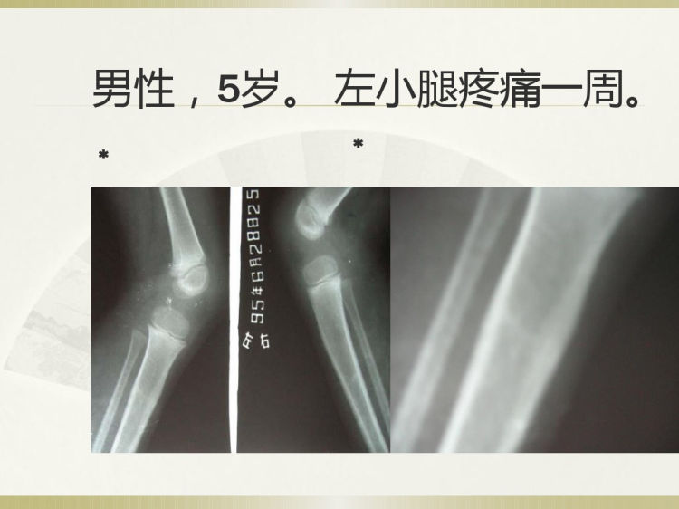 应力性骨折影像学诊断PPT