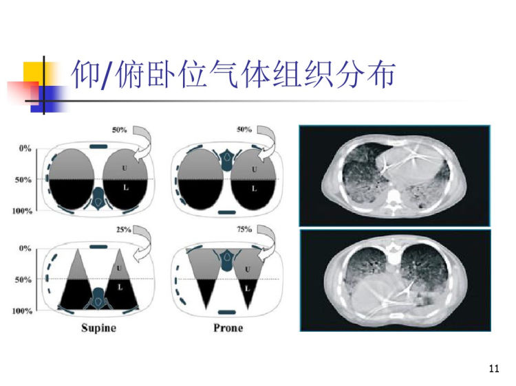 俯卧位通气PPT