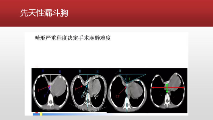 小儿胸科手术麻醉管理PPT