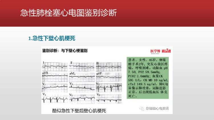 易漏诊误诊肺栓塞心电图特点PPT