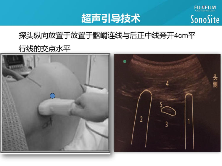 超声引导下肢神经阻滞PPT