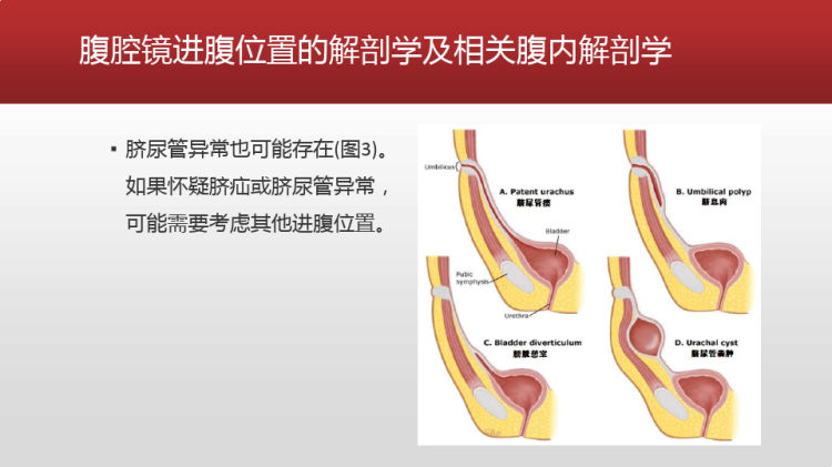 腹腔镜进腹技巧与常见问题及对策PPT