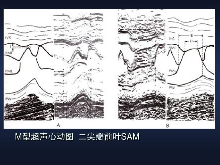 肥厚性心肌病PPT课件