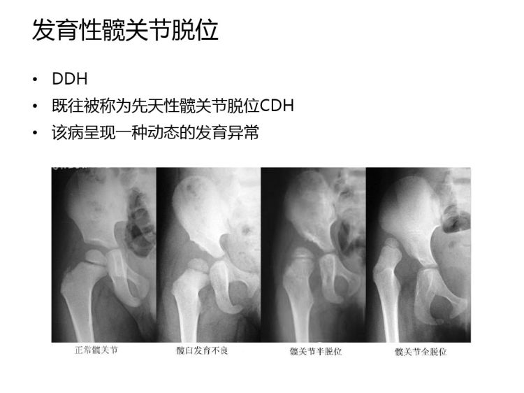 发育性髋关节脱位筛查方法PPT