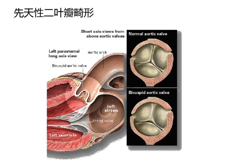 主动脉瓣狭窄PPT