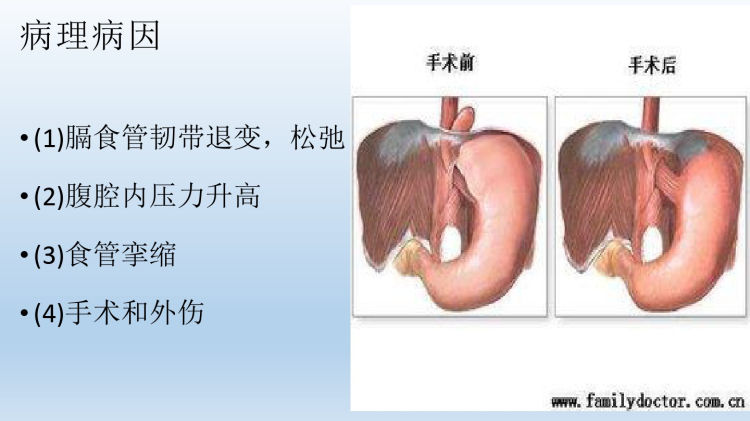 食管裂孔疝护理查房PPT