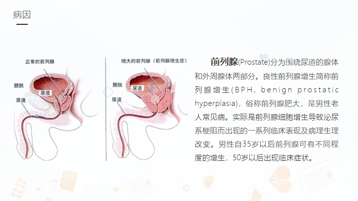 前列腺增生护理业务学习PPT