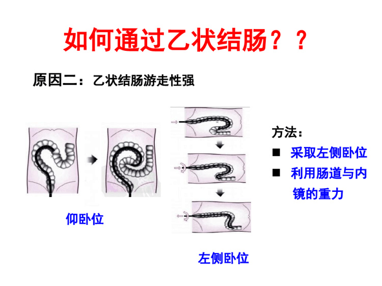 肠镜检查辅助技巧PPT