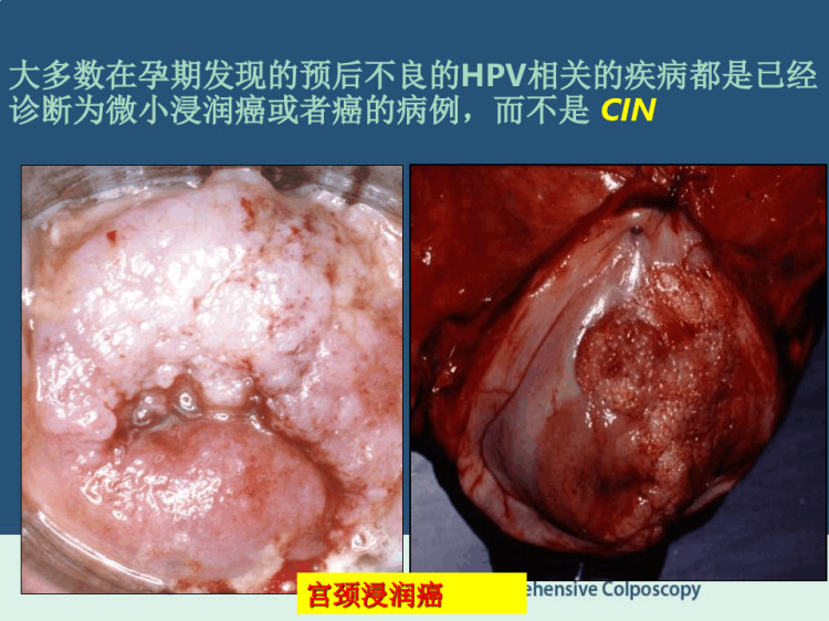 ColpoPregnancyEAS中文版PPT