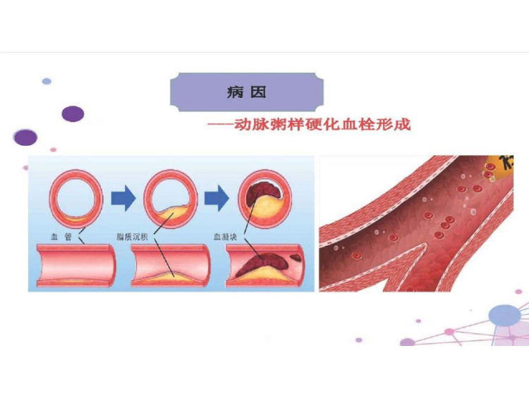 大面积脑梗介入手术围术期护理PPT