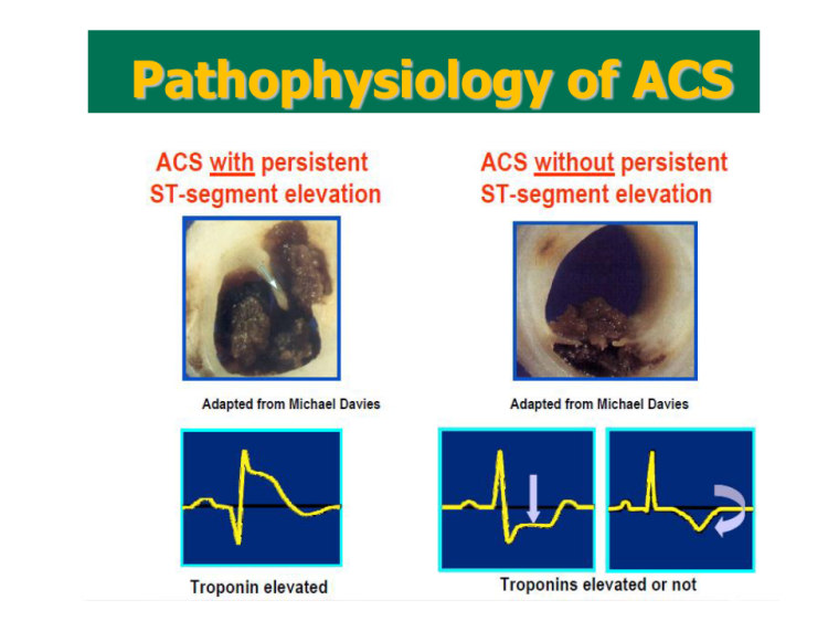 急性冠脉综合征诊治PPT