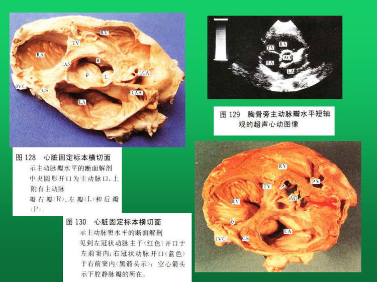 心脏断面解剖及室壁心段PPT