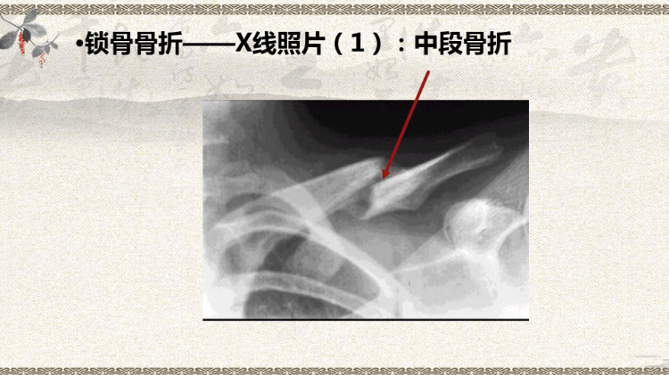 中医伤科上肢骨折PPT