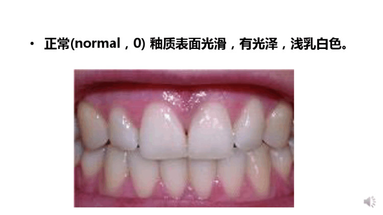 口腔预防医学之氟牙症微课PPT