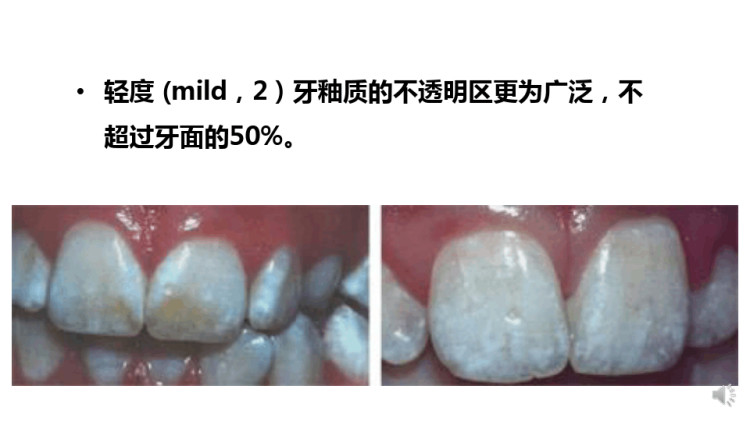 口腔预防医学之氟牙症微课PPT