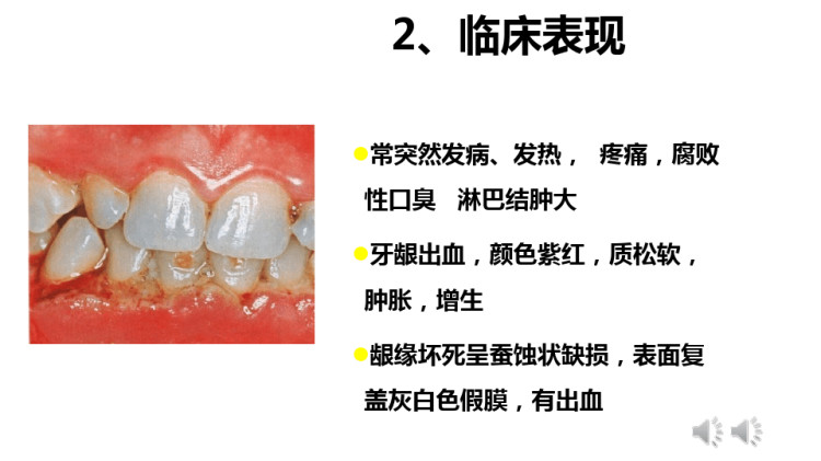 口腔组织病理学之非菌斑性牙龈病PPT