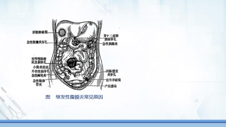 急性弥漫性腹膜炎——病因与病理生理PPT