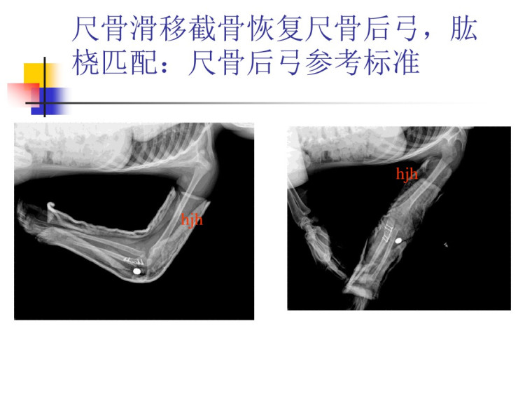 前臂骨折及影像表现PPT