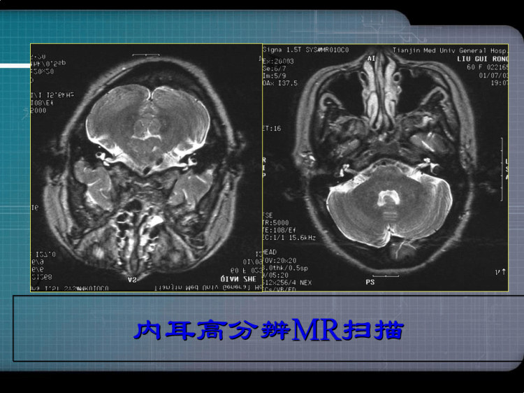 头颈部耳部影像诊断PPT